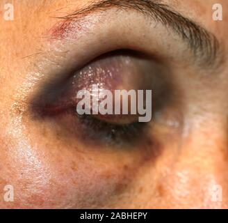 Ein blauer Fleck in der Nähe des Auges. Hämatome im Gesicht bei einem Schlag. Augenverletzungen. Stockfoto