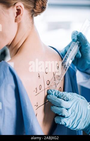 7/8-Ansicht von allergist in Latex Handschuhe holding Herrscher in der Nähe von Patienten mit Rücken gekennzeichnet Stockfoto