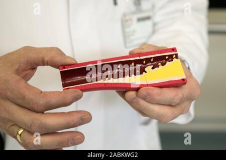 Kardiologie Chefarzt Stefan Sack zeigt ein Modell einer Koronararterie im Herzkatheterlabor der Neuperlach Städtische Klinik. Die gelbe ist Plaque. [Automatisierte Übersetzung] Stockfoto