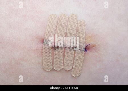 Nahaufnahme der menschlichen Haut mit Naht und den Wundverschluss Streifen oder chirurgischen Band nach Mole oder Melanom Biopsie Stockfoto