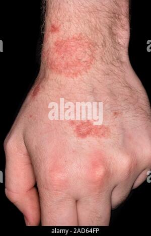 Kontaktdermatitis. Nahaufnahme von einem hautausschlag am Handgelenk eines  22-jhrigen mnnlichen Patienten mit Dermatitis (Hautentzndung) durch eine  Reaktion auf somethin Stockfotografie - Alamy