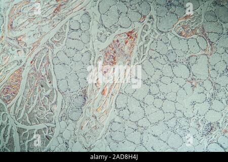 Amyloidablagerungen in der Zunge krankes Gewebe unter dem Mikroskop 200x Stockfoto