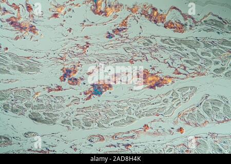 Amyloid-ablagerungen im Herzen erkrankte Gewebe unter dem Mikroskop 200x Stockfoto