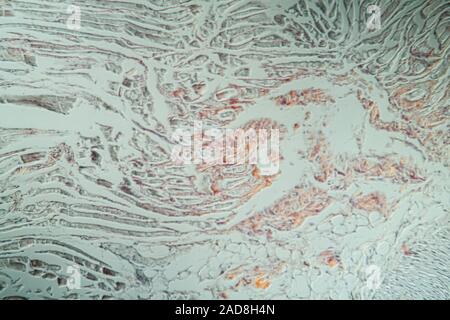 Amyloidablagerungen in der Zunge krankes Gewebe unter dem Mikroskop 200x Stockfoto