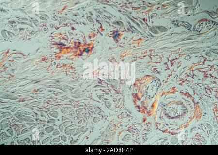 Amyloid-ablagerungen im Herzen erkrankte Gewebe unter dem Mikroskop 200x Stockfoto