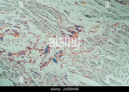 Amyloid-ablagerungen im Herzen erkrankte Gewebe unter dem Mikroskop 200x Stockfoto