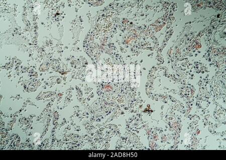 Amyloidablagerungen in der Lunge krankes Gewebe unter dem Mikroskop 200x Stockfoto
