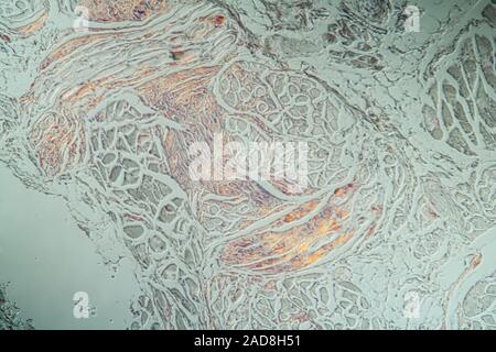 Amyloidablagerungen in der Zunge krankes Gewebe unter dem Mikroskop 200x Stockfoto