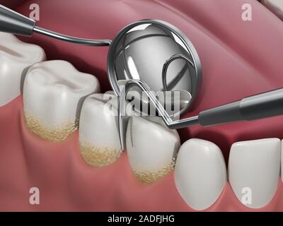 3D-Abbildung: Zahnarzt Werkzeuge und Zahnbelag nach Modell. 3D-Darstellung. Stockfoto