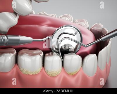 3D-Abbildung: Zahnarzt Werkzeuge und Zahnbelag nach Modell. 3D-Darstellung. Stockfoto