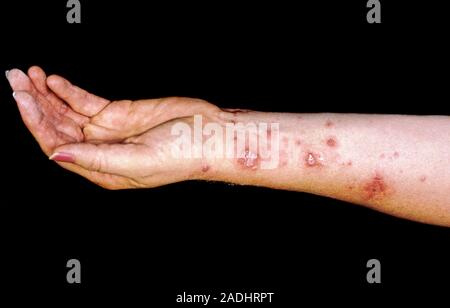 Ivy Allergie. Arm einer Frau mit einem entflammten Hautausschlag verursacht  durch eine allergische Reaktion auf Poison Ivy (Toxicodendron radicans). Es  gibt viele rote, Flssigkeit Stockfotografie - Alamy