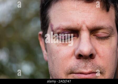 Ein weißer Mann mit Stoppeln mit einem Lila schwarz Auge und Kopf Verletzung - Augen geschlossen Stockfoto