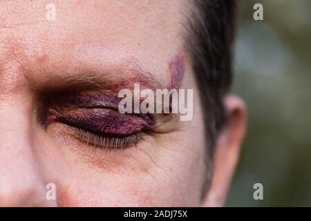 Nahaufnahme von einem weißen Mann mit einem Lila schwarz Auge und Kopf Verletzung - Auge geschlossen Stockfoto