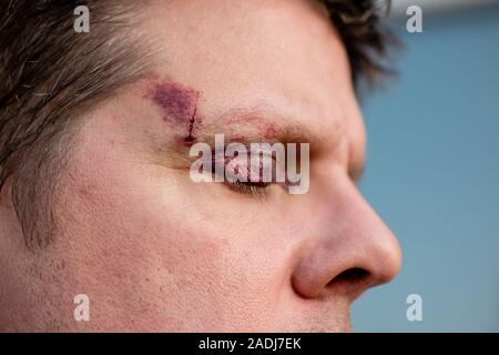 Ein weißer Mann mit einem Lila schwarz Auge und Kopf Verletzung - die Augen geschlossen, Seitenansicht Stockfoto