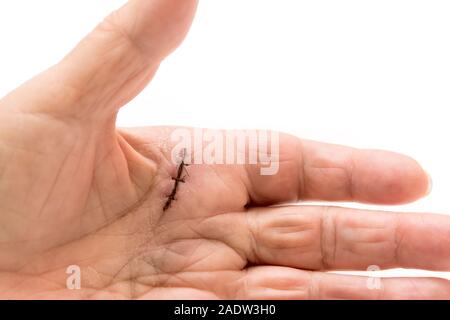 Nahaufnahme eines OP-Narbe von dupuytren's disease oder stenosing Sehnenscheidenentzündung, weißer Hintergrund Stockfoto