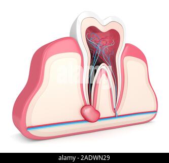 3D-Render von Zahn in Gummis mit Zyste. Zahnmedizinisches problem Konzept. Stockfoto