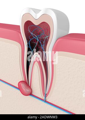 3D-Render von Zahn in Gummis mit Zyste. Zahnmedizinisches problem Konzept. Stockfoto