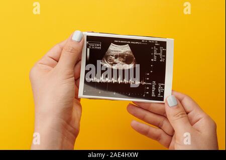 Ultraschall medizinische Foto in Frau Hände Nähe zu sehen. Stockfoto