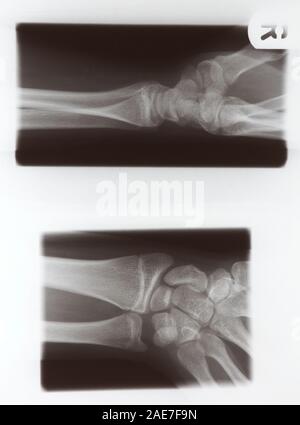 X-Ray von Hand und Handgelenk Stockfoto