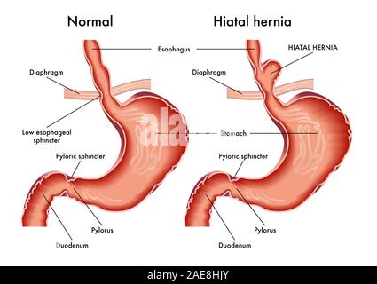 Medizinische Illustration der Magen mit hiatal Hernie mit Beschriftung. Stockfoto