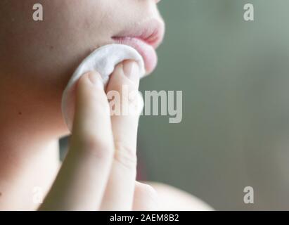 Der Teenager drückt mit einem Wattepad mit Cleansing Lotion auf ihrem Gesicht. Der Kampf gegen die Akne. Stockfoto