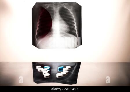 Tuberkulose Behandlungskonzept. Röntgenaufnahme der Lunge, mit Pathologie, phonendoscope mit Pillen auf den Tisch. Lungenerkrankung. Lungenentzündung. Medizinische Flatley, p Stockfoto