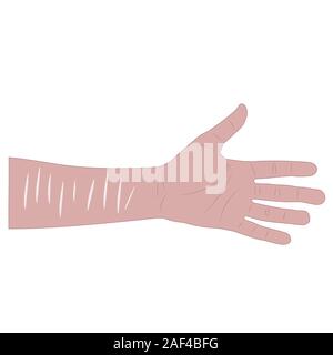 Hand mit Narben am Handgelenk nach Selbstmordversuch. isolierte Lager Vector Illustration Stock Vektor