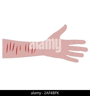 Männliche hand mit blutigen Schnitte am Handgelenk nach Selbstmordversuch. isolierte Lager Vector Illustration Stock Vektor