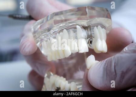 Der Kieferorthopäde hält ein Modell der Zähne mit Implantaten in der Hand und zeigt, wie der Zahn einfügen Stockfoto