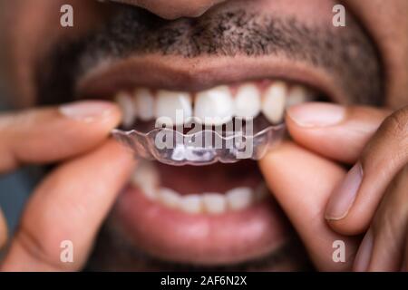 Close-up In eines Mannes Hand Transparent Ausrichter in Zähne Stockfoto