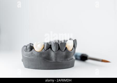Close-up auf Putz Modell der in schwarzem Kunstleder Kiefer mit Implantat Krone und Pinsel auf dem weißen Hintergrund gemalt. Konzept der ästhetischen Zahnheilkunde und Implantation Stockfoto