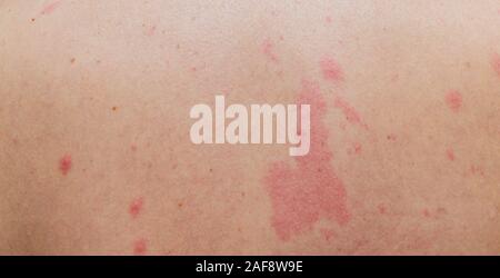 Close up Allergie Hautausschlag, um die Rückseite des menschlichen mit Dermatitis Problem der Ausschlag, Allergie Hautausschlag und gesundheitlichen Problem Stockfoto