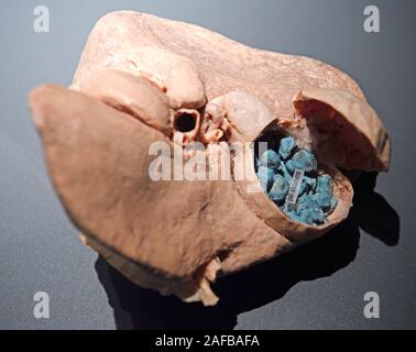 Präparat, Plastinat, Gallenblase mit Gallensteinen, Lehrwerk Museum, Berlin, Deutschland Stockfoto