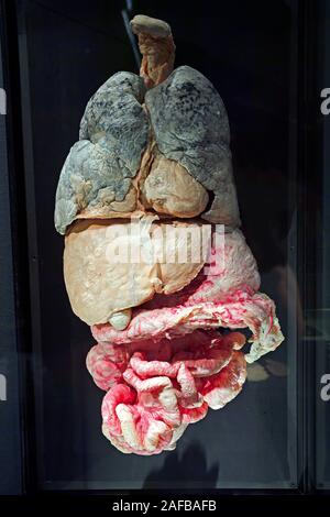 Präparat, Plastinat, innere Organe mit Metastasen, Lehrwerk Museum, Berlin, Deutschland Stockfoto