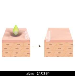 Aknenarben. Acid peeling Narbe atrophische Behandlung. Die anatomische Struktur der Haut mit Akne. Vector Illustration auf isolierte Hintergrund. Stock Vektor