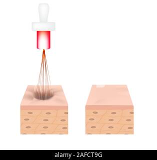 Aknenarben. Laser Narben atrophische Behandlung. Die anatomische Struktur der Haut mit Akne. Vector Illustration auf isolierte Hintergrund. Stock Vektor