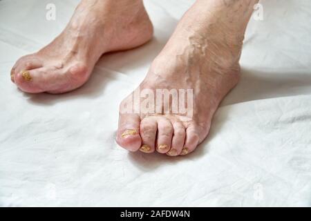 Nahaufnahme von einem Fuß mit beschädigter Nägel, weil der Pilze. Ältere Frau Beine. Diabetis Stockfoto