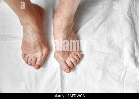 Nahaufnahme von einem Fuß mit beschädigter Nägel, weil der Pilze. Ältere Frau Beine. Diabetis Stockfoto