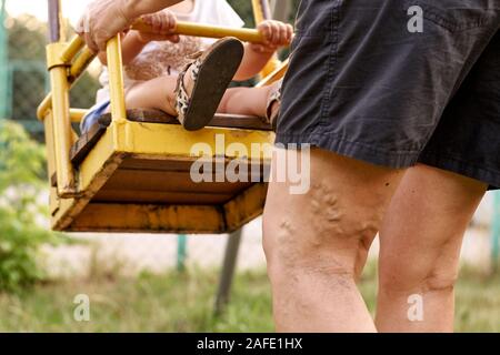 Schmerzhafte Krampfadern und Besenreiser auf womans Beine, der aktiv ist, sich selbst zu helfen. Gesundheitswesen Stockfoto