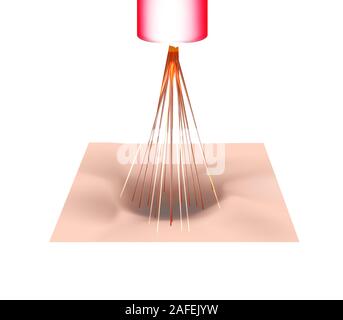 Aknenarben. Laser Narben atrophische Behandlung. Die anatomische Struktur der Haut mit Akne. Vector Illustration auf isolierte Hintergrund. Stock Vektor