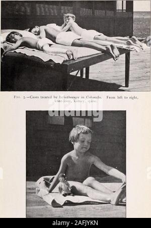 . Transaktionen der Amerikanischen klimatologische und klinische Assoziation.. Kic. 2.-Albino die ersten Sonnenbad.. Abb. 4. - Heliotherapie in Colorado. Tuberkulose der Knie-Gelenk. Heliotherapie in Colorado 185 Anzahl der roten Blutkörperchen. Diese Effekte können oft durch die Verwendung von verschiedenen Bädern oder Massagen, die in der Regel auch eine oberflächliche Staus tocause beobachtet werden; aber bei der Verwendung der Solar energyon der Haut gibt es eine Kraft, die, vielleicht, morepotent ist und weitreichende in seiner Wirkung auf den Menschen als alle otherrays zusammen, und diese sind die Aktinische oder UV-Strahlung, auch genannt das Dunkle oder chemische Stockfoto