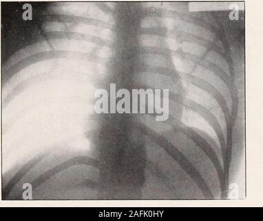. Transaktionen der Amerikanischen klimatologische und klinische Assoziation.. unverhältnismäßige auf die ruhige Atmung,,und ihre relative Werte haben immer konsequent Main gewesen. Wegen dieser Funktion und der subjektiven symptomsthe bedeuten, war der Druck auf o, oder ein bisschen weniger reduziert. Thisreduction vermindert das Gefühl der Müdigkeit etwas und thepulse, die 90 gemittelt hatte, fielen zu einem festen rate von 80 aftertwo Wochen. Das sputum, klein in der Höhe, wurde aber littleinfluenced. Die körperlichen Zeichen in der rechten oberen lobe etwas havediminished. Den allgemeinen Zustand des patienthas materiell Stockfoto
