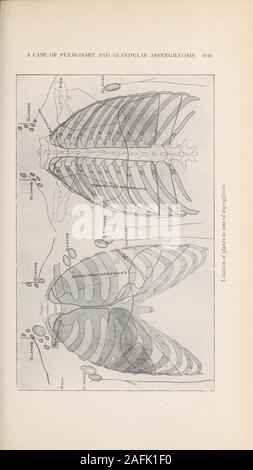 . Transaktionen der Amerikanischen klimatologische und klinische Assoziation.. Mit knappen expectoration oz.in twentv - vier Stunden), andthis angehoben mit Schwierigkeiten. Keine Kehle Symptome. Appetiteverv Armen. Verdauung beeinträchtigt. Darm regelmäßig. Keine Nightsweats oder Schüttelfrost. Beide Wangen gespült. Schlafen Schlecht, Durchschnittlich von einem bis zu fünf Stunden, und nicht erfrischend. Männer - struation abwesend für drei Monate vor der Zulassung. Prüfung. Patienten greatlv abgemagert. Ausdruck erstellt andanxious, gelbliche Haut, Schleimhäute blass; markedanemia. Zähne in einem guten Zustand, der Zunge rot, tonsilsnormal; Nase, Hals und Ohren neg Stockfoto
