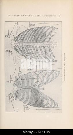 . Transaktionen der Amerikanischen klimatologische und klinische Assoziation.. Mit knappen expectoration oz.in twentv - vier Stunden), andthis angehoben mit Schwierigkeiten. Keine Kehle Symptome. Appetiteverv Armen. Verdauung beeinträchtigt. Darm regelmäßig. Keine Nightsweats oder Schüttelfrost. Beide Wangen gespült. Schlafen Schlecht, Durchschnittlich von einem bis zu fünf Stunden, und nicht erfrischend. Männer - struation abwesend für drei Monate vor der Zulassung. Prüfung. Patienten greatlv abgemagert. Ausdruck erstellt andanxious, gelbliche Haut, Schleimhäute blass; markedanemia. Zähne in einem guten Zustand, der Zunge rot, tonsilsnormal; Nase, Hals und Ohren neg Stockfoto