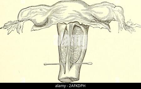 . Die Diagnose, Pathologie und Behandlung von Krankheiten von Frauen einschließlich der Diagnose der Schwangerschaft., jedoch vollständig in zwei durch ein Septum runningdown der Mitte geteilt. Diese kussmaul Begriffe der Uterus duplex Abb. 59.. Stockfoto