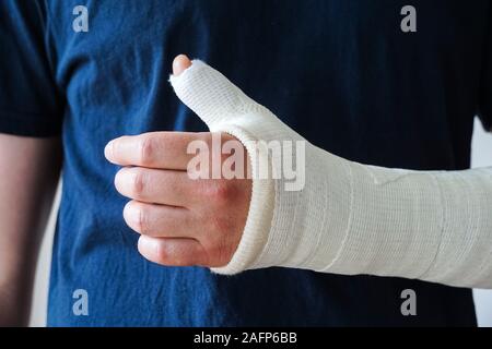 Mann mit Gips auf gebrochene Hand gegossen, gebrochenen Daumen, gebrochenes Handgelenk Stockfoto