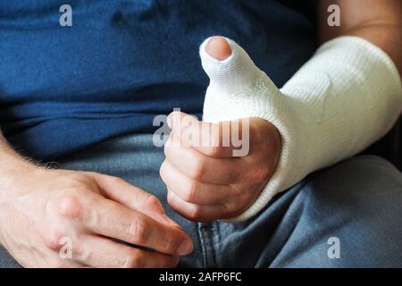 Mann mit Gips auf gebrochene Hand gegossen, gebrochenen Daumen, gebrochenes Handgelenk Stockfoto