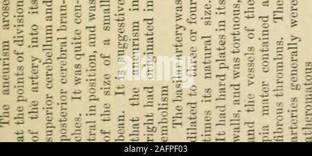 . St. Thomas's Hospital reports. ^^>^X s .2 b e c ej^ CO c ,2 3 - - v>"-a:. 5> -.-. a i?-n:M X-^r, H> Li^? Ich 2. 1 G8 intrakranieller Aneurysmen o.Ä.. &Gt;t F., Aet. 61, im Dienst von M. an das Fremy 6 tcl Dieu, lange Wertminderungen von ofintelligence und Motor Leistung gelitten, mit involun- Passage von Evakuierungen, und hatte einen oldgoitre. Zwei Monate vor seinem Tod hatte fallenon linke Seite und verlor die Verwendung der linken Arm. Wenn zugegeben hatte, teilweise Hemiplegie des Fernsehgerätes. Sie starb im Koma in vier Tagen. F., a; t. 26, hatte chancre sechs Jahre beforefollowed von Halsschmerzen. Hatte zwei distinctattack Stockfoto