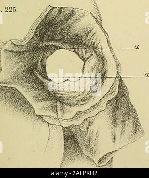 . Erkrankungen des Herzens und der thorakalen Aorta. Abb.,. Stockfoto