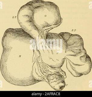 . Klinische gyncology, medizinische und chirurgische. d im unteren Bereich der Gebärmutter ein Prozess der Evolution indie Cervix zu unterziehen, wie in Duchemins bei Strasburg Klinik. Die positionder Gebärmutter in das Becken mit der Situation der Wachstum variiert. Es isgenerally vorher verdrängt, oder posterior oder lateral; weniger oft wefind es erhöhten oder tief unten im Becken. Wenn das Wachstum developssomewhat seitlich in das untere Segment des posterioren Oberfläche, mit einem 558 BEXIGX Neubildungen der Gebärmutter. subperitoneal Evolution, der Becken- Inhalte sind oft schwer interferedwith und Th Stockfoto